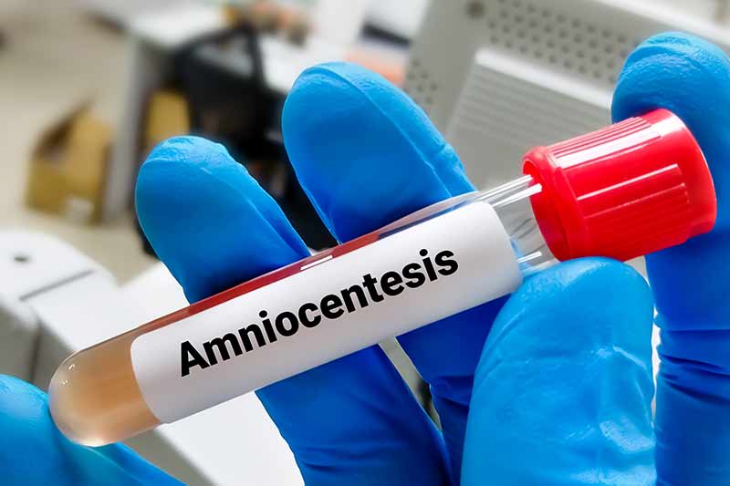 Amniocentesis test cost